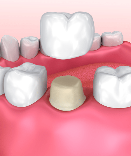 Treatment - Smilecare Dental Clinic